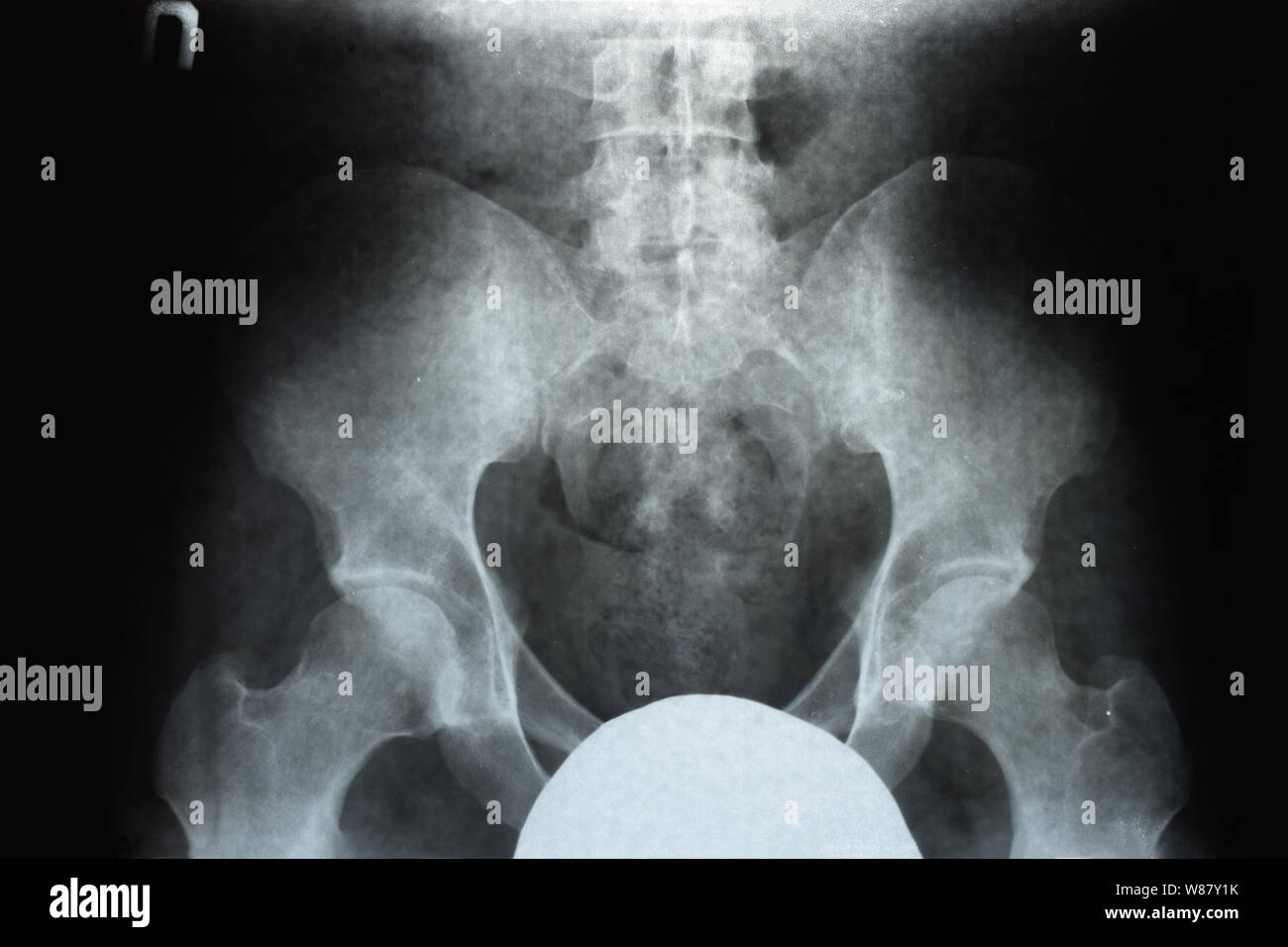 X-ray of the pelvis and sacrum. X-ray image. Stock Photo