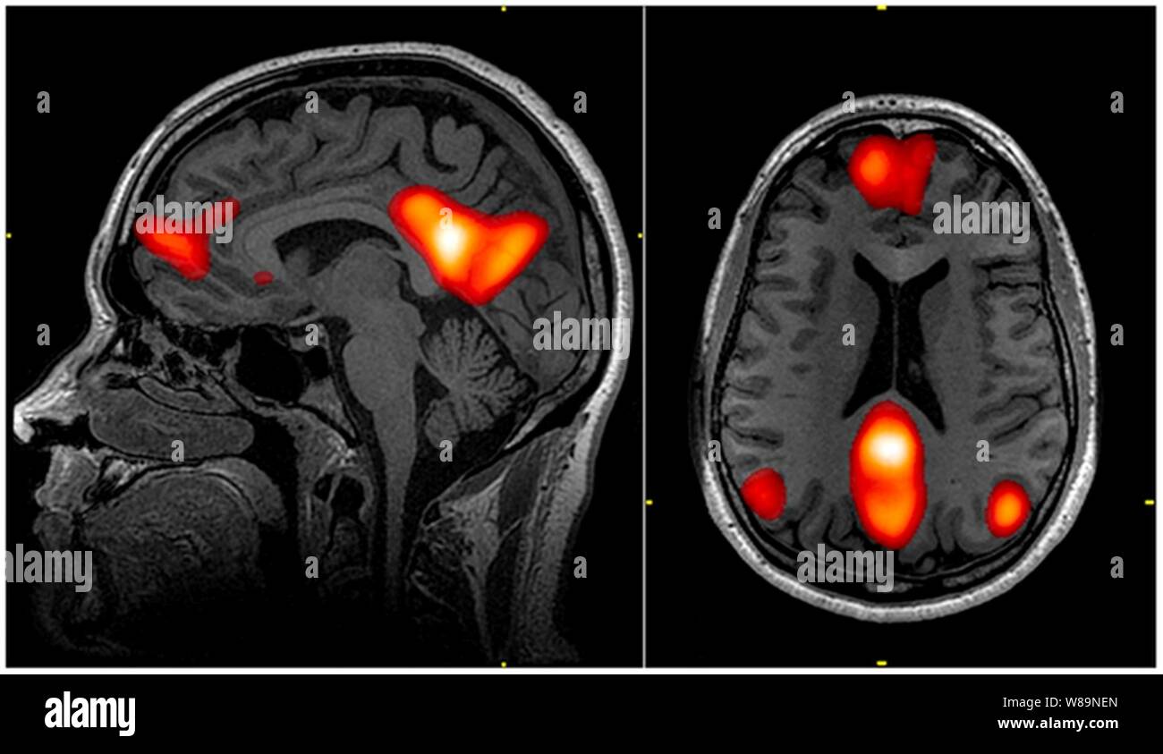 Default mode network wrnmmc stock photo alamy