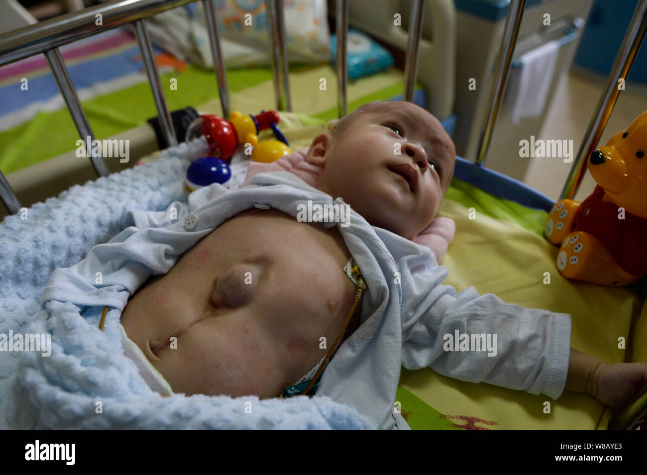 Newborn baby An An, who suffers from heart protrusion, is pictured before an operation at the Children's Hospital of Chongqing Medical University in C Stock Photo