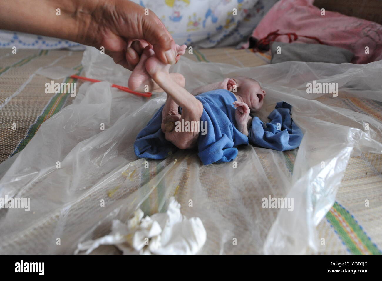 Threemonthold Guo Enze with an imperforate anus cries as his