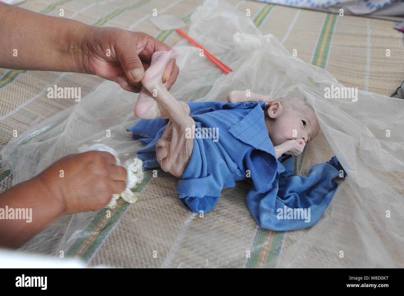 Threemonthold Guo Enze with an imperforate anus reacts as his