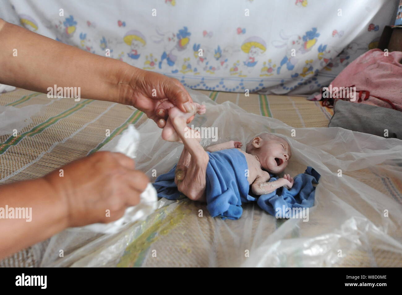 Threemonthold Guo Enze with an imperforate anus cries as his