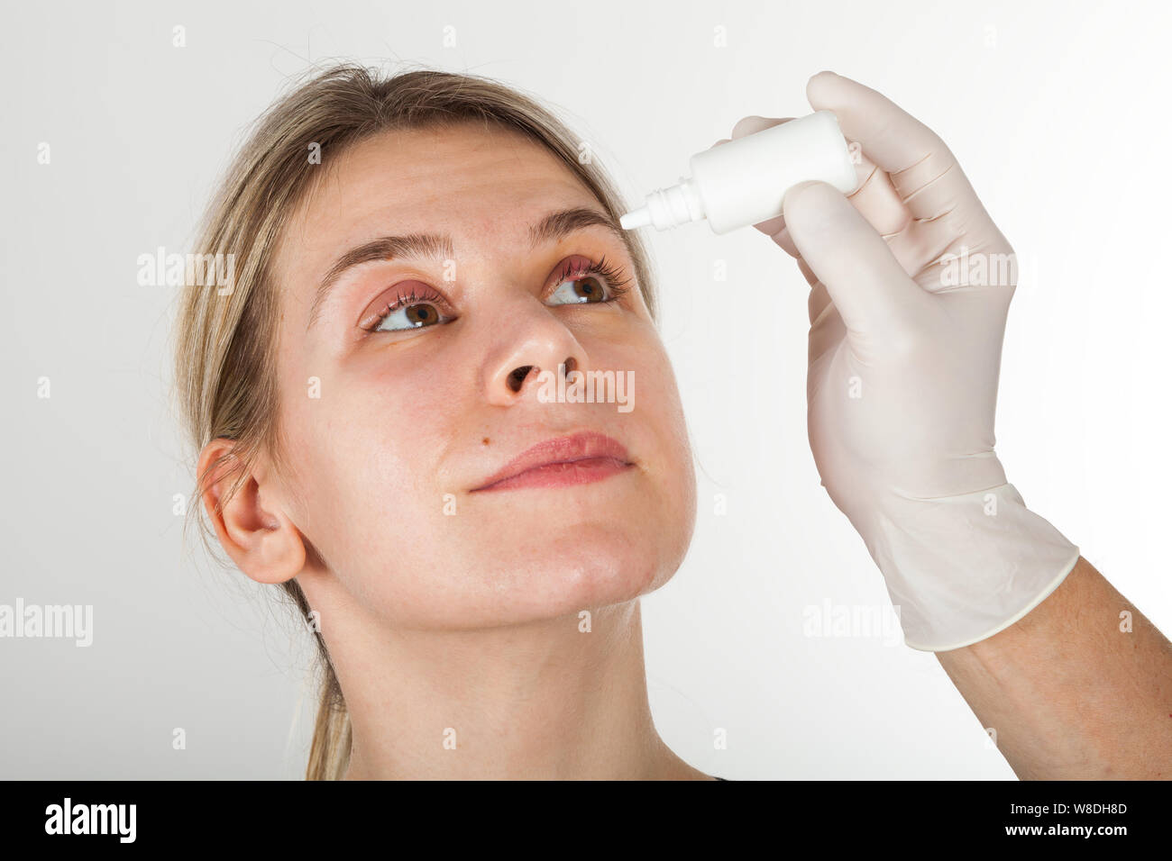 Portrait of a young woman with severe eye infection  - isolated background Stock Photo