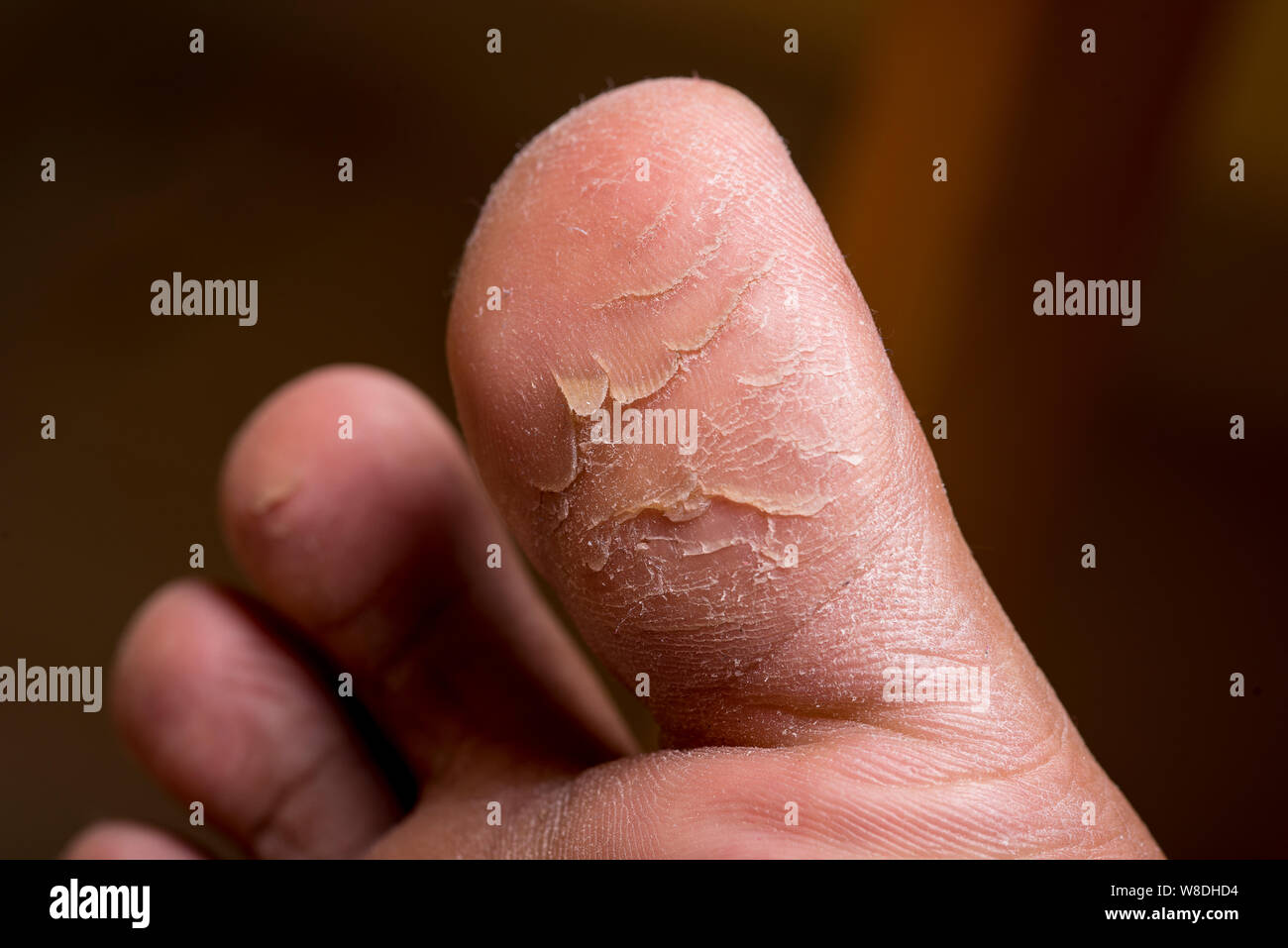 A skin disorder called Callus occurs on feet toe closeup Stock Photo ...