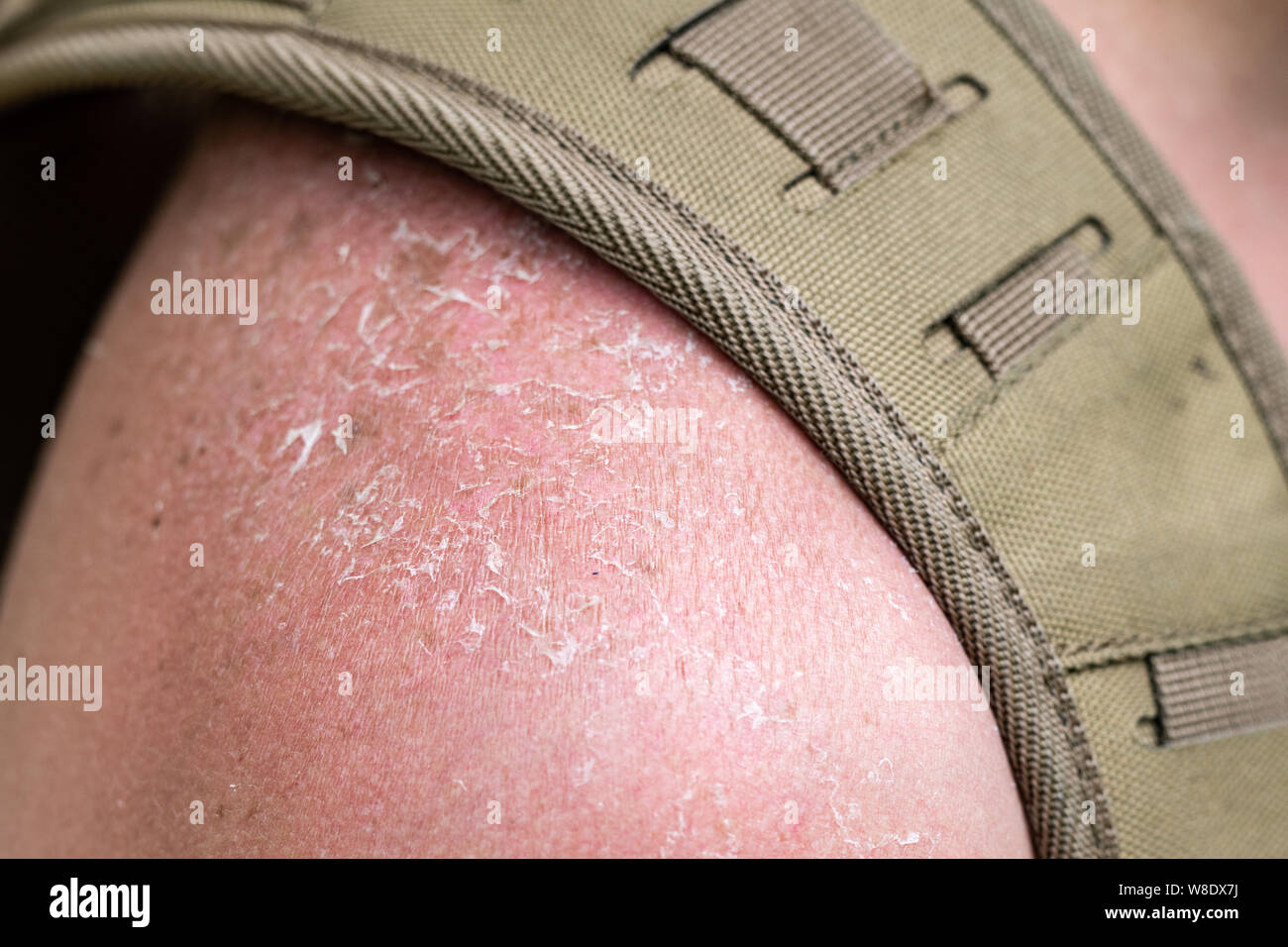 the skin on the tourist s shoulder is cracked and peeling off after a sunburn Stock Photo