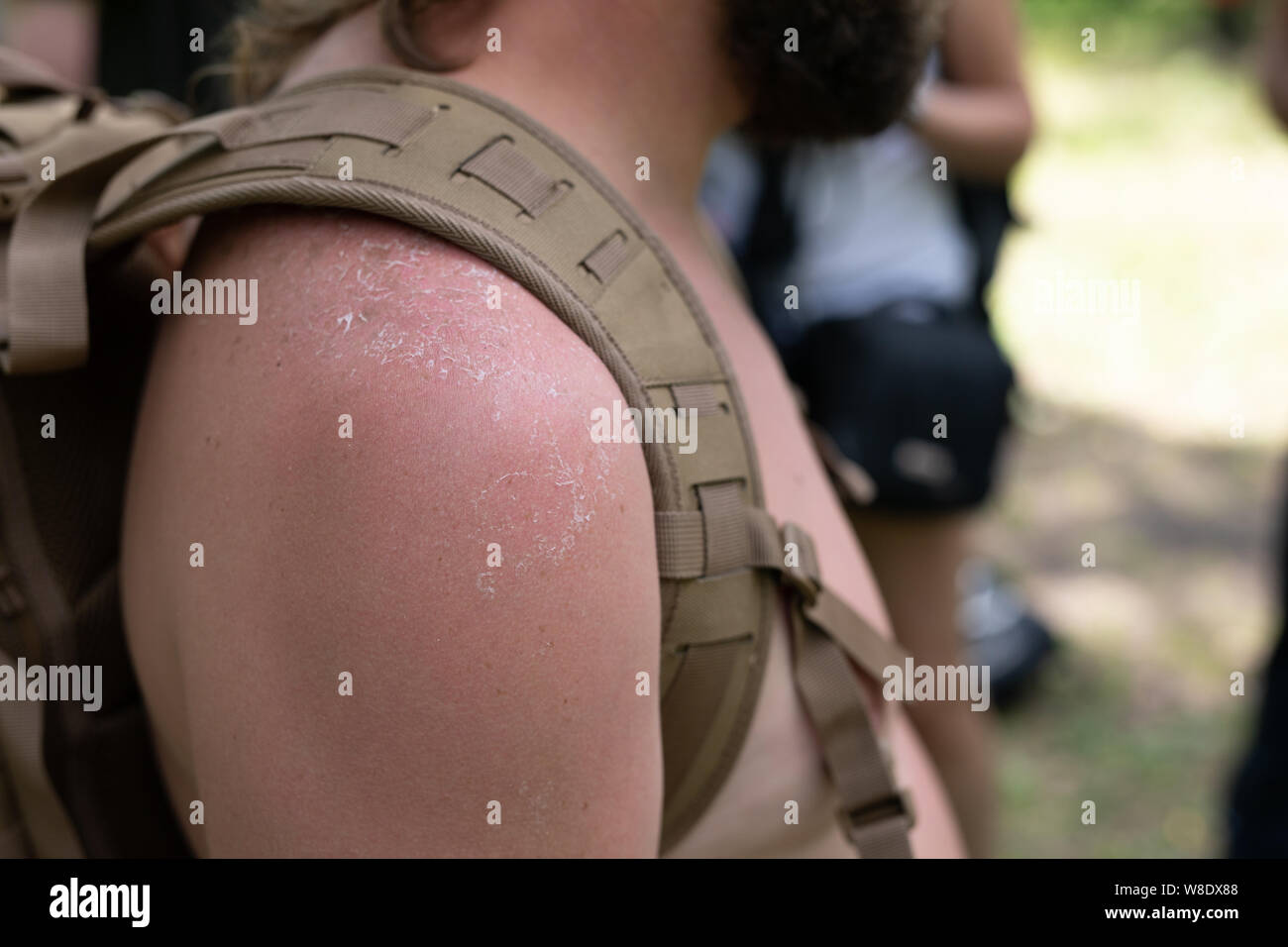 Sunburned shoulder with a backpack strap close-up. Sunburn of the skin. Stock Photo