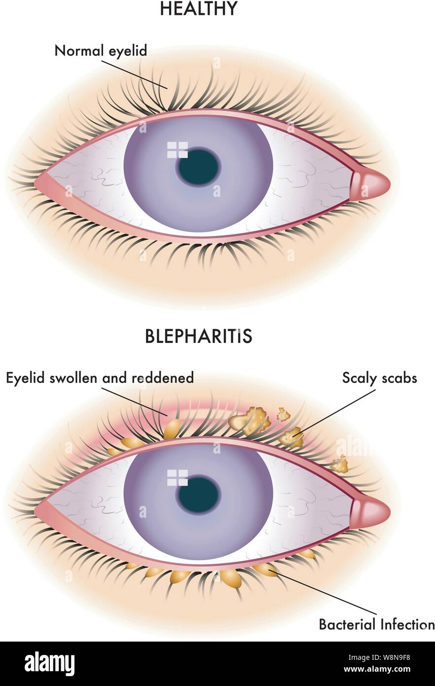 Medical illustration of the symptoms of blepharitis. Stock Vector
