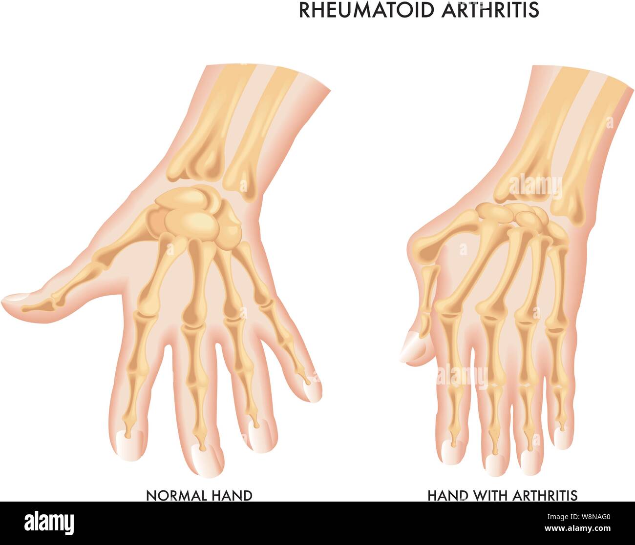 Hands After Rheumatoid Arthritis For Forty Years Woman With Arthritis Who  In Some Finger Joints Has Been Stiffened Heberdean Nodules Stock Photo -  Download Image Now - iStock