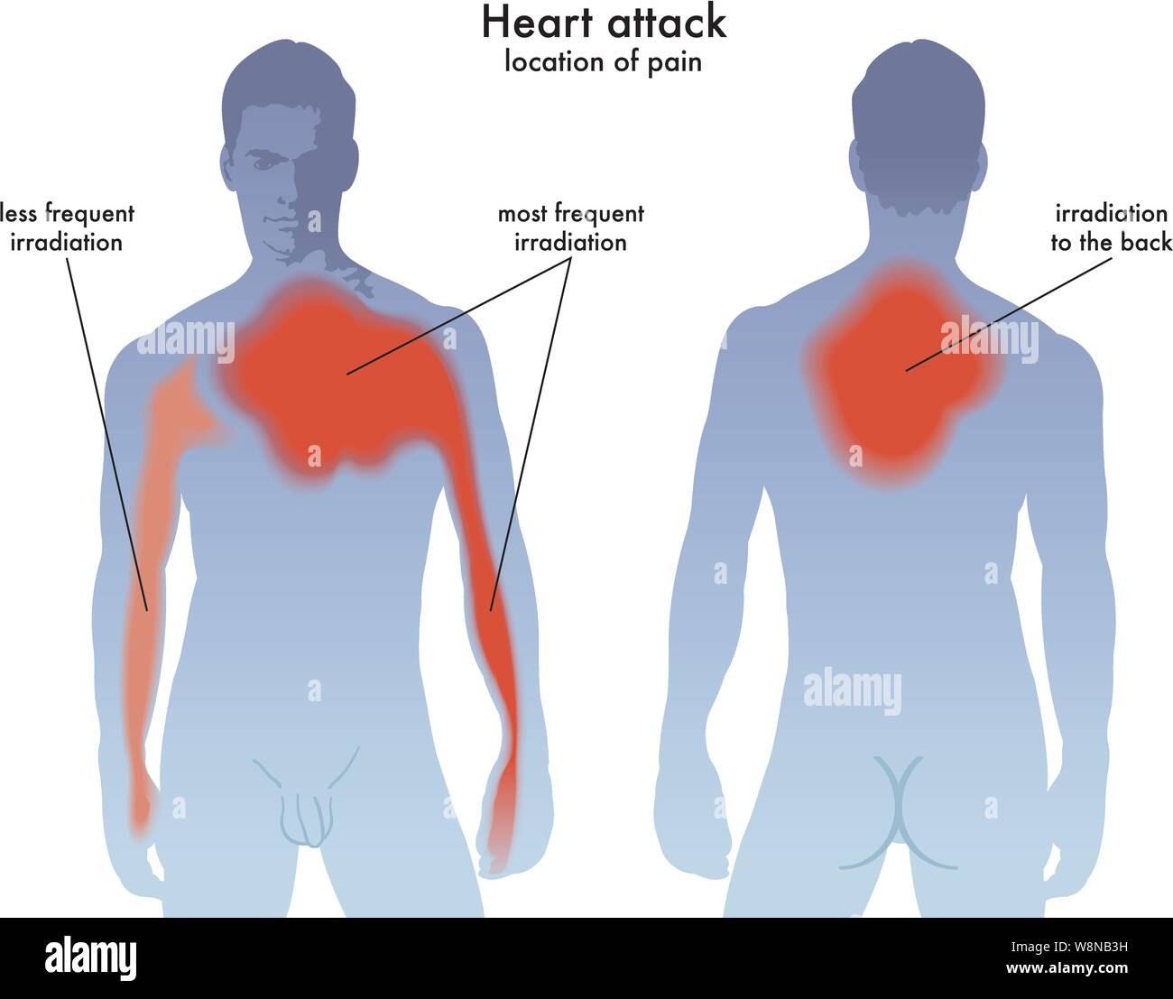 Heart Attack Diagram