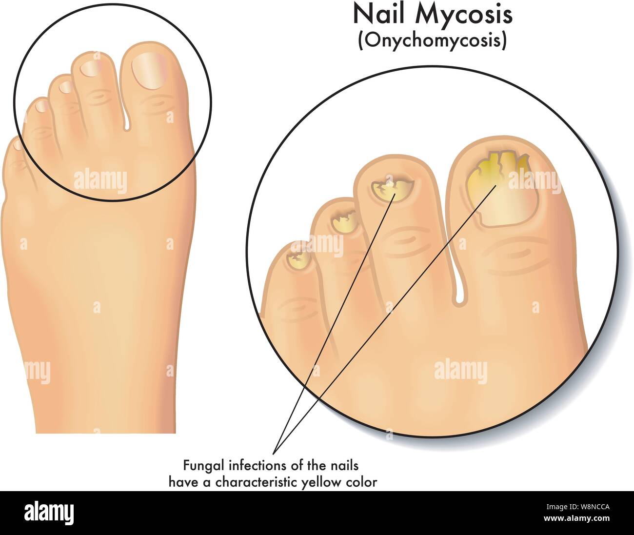 Medical illustration of the symptoms of nail mycosis Stock Vector
