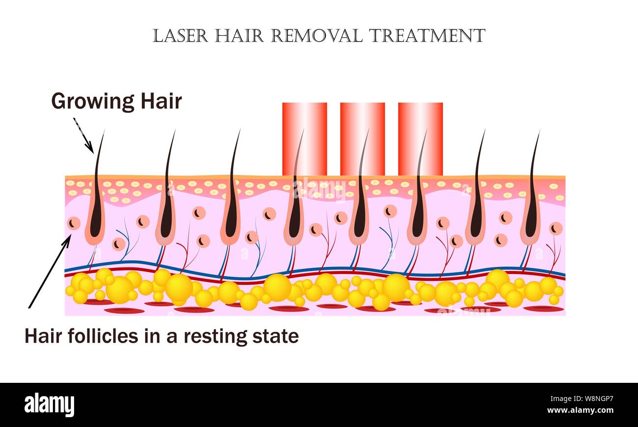 Laser Hair Removal treatment. Procedure causes damage to the hair follicle without hurting the skin tissue and hair folicles in the resting state. Stock Vector