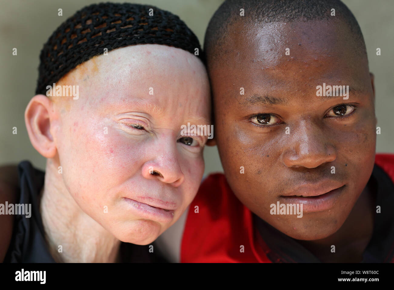 Albino mother and son in Ukerewe, Tanzania. Many traditional healers have been arrested recently in Tanzania because of albino murders Stock Photo