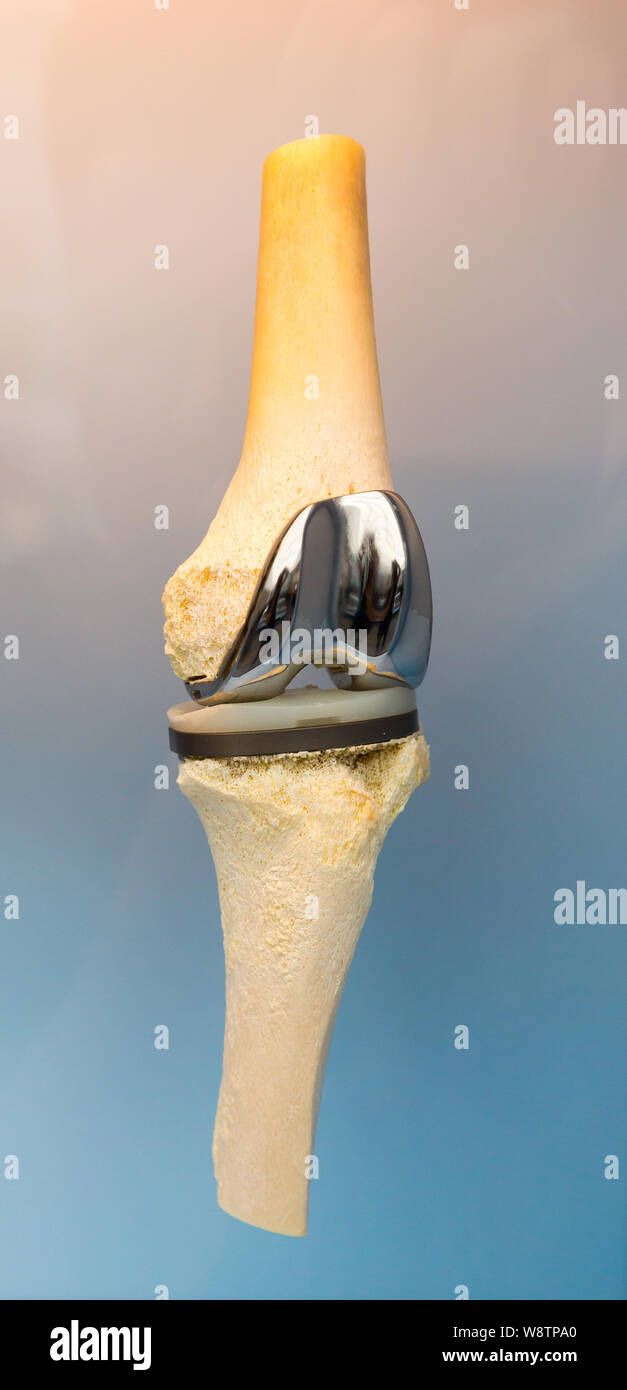 Human joint prosthesis , metal implant Stock Photo