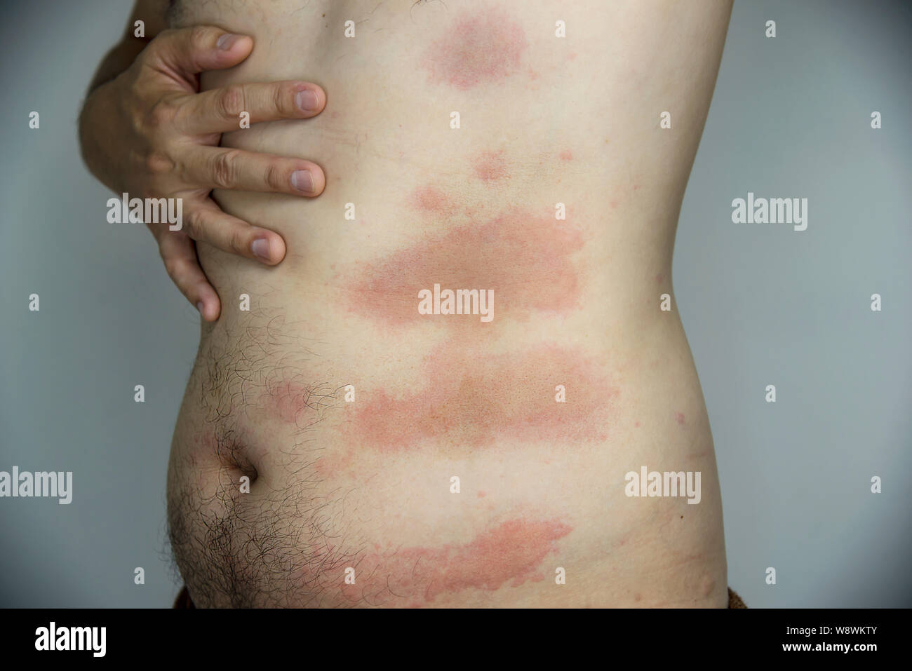Man getting red skin rash at his body part - people with skin allergy problem concept Stock Photo