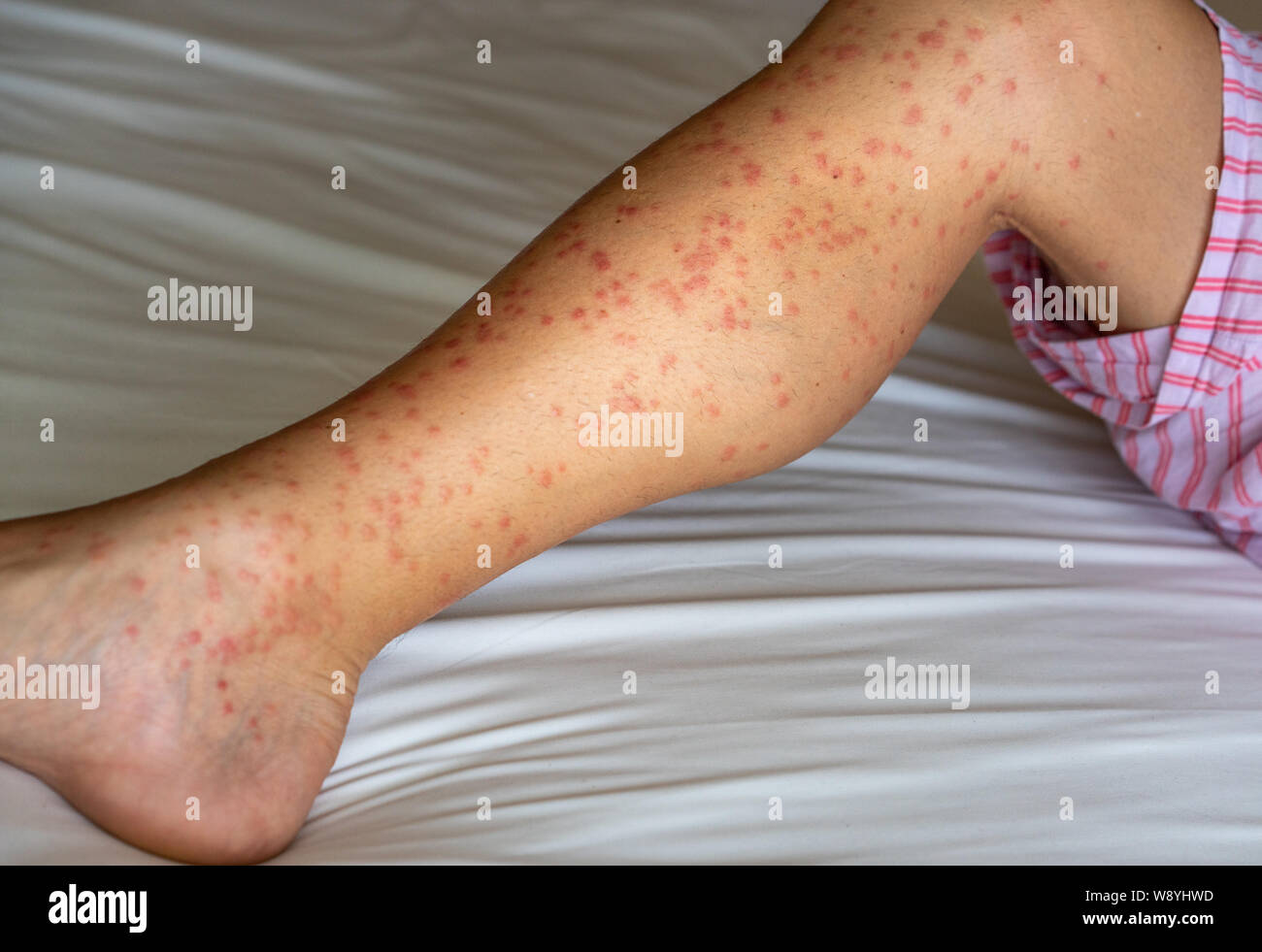 Close up of redness, itching and swelling after many mosquitos bite on the leg - allergy to mosquito saliva can cause papular hives or Skeeter's syndr Stock Photo