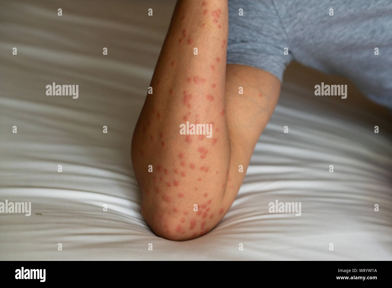 Close up of redness, itching and swelling after many mosquitos bite on the arm - allergy to mosquito saliva can cause papular hives or Skeeter's syndr Stock Photo