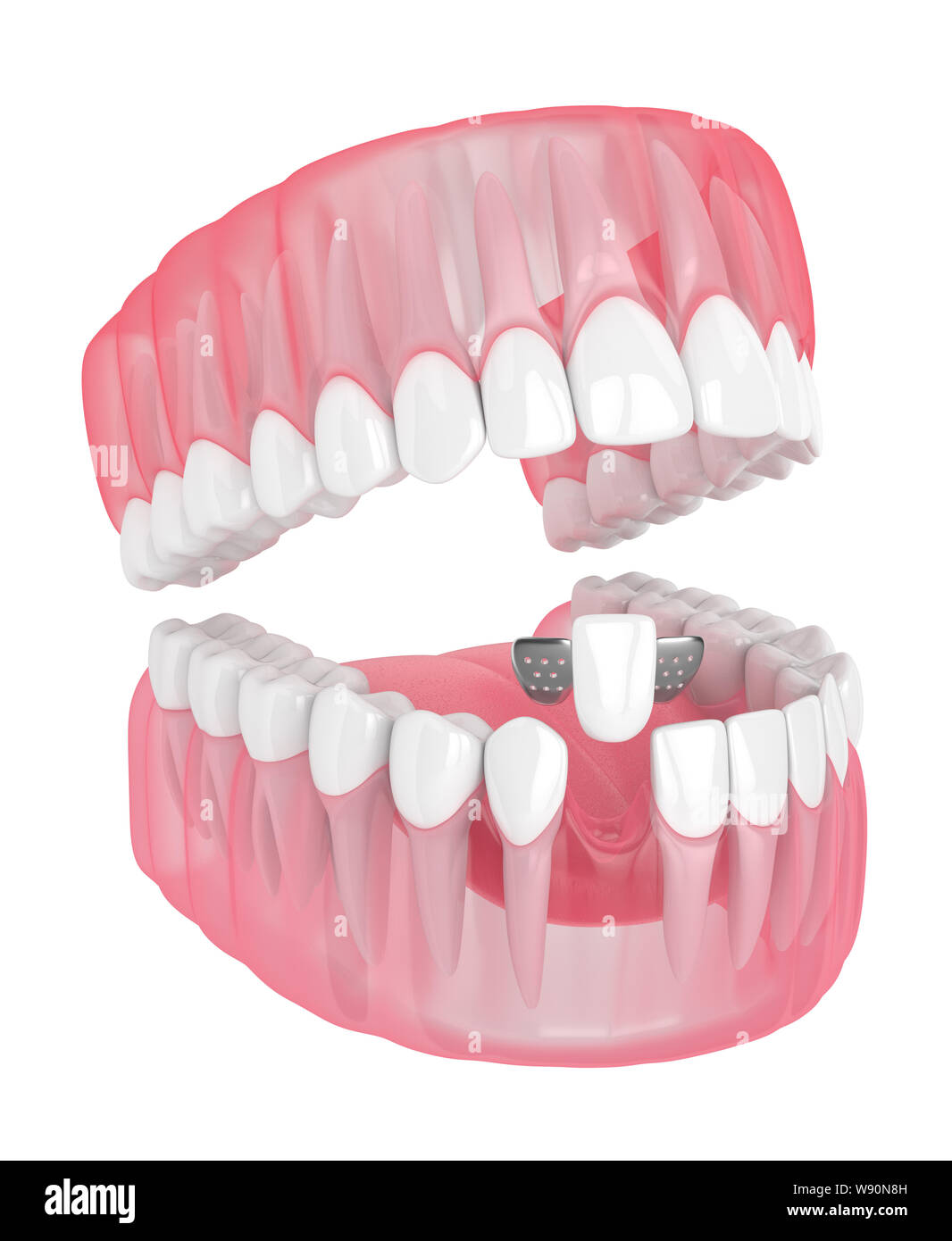 3d render of jaw with teeth and maryland bridge over white background ...