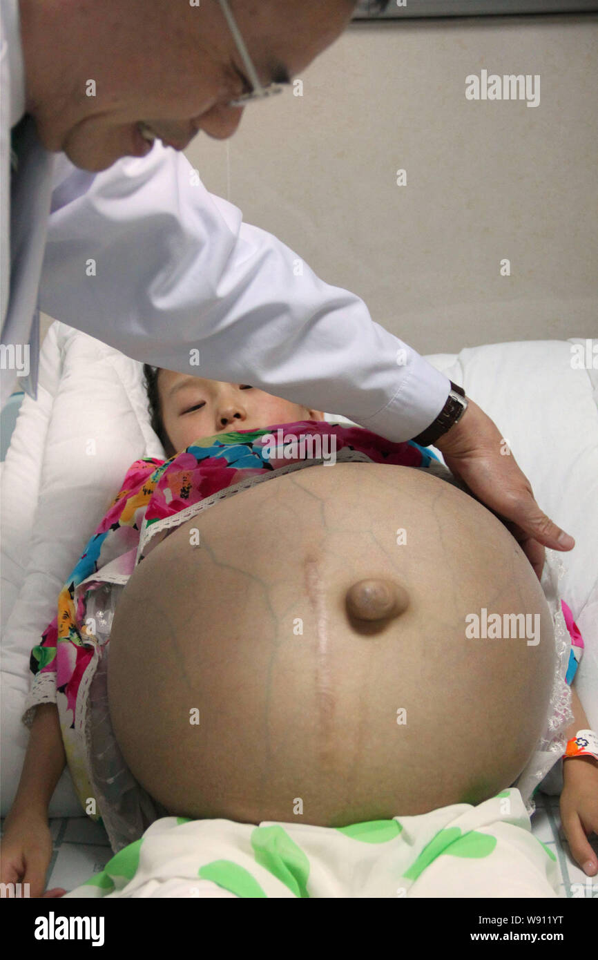 A doctor examines 12-year-old girl Han Bingbing who suffers from a giant tumor in her belly at Fuda Cancer Hospital in Guangzhou city, south Chinas Gu Stock Photo