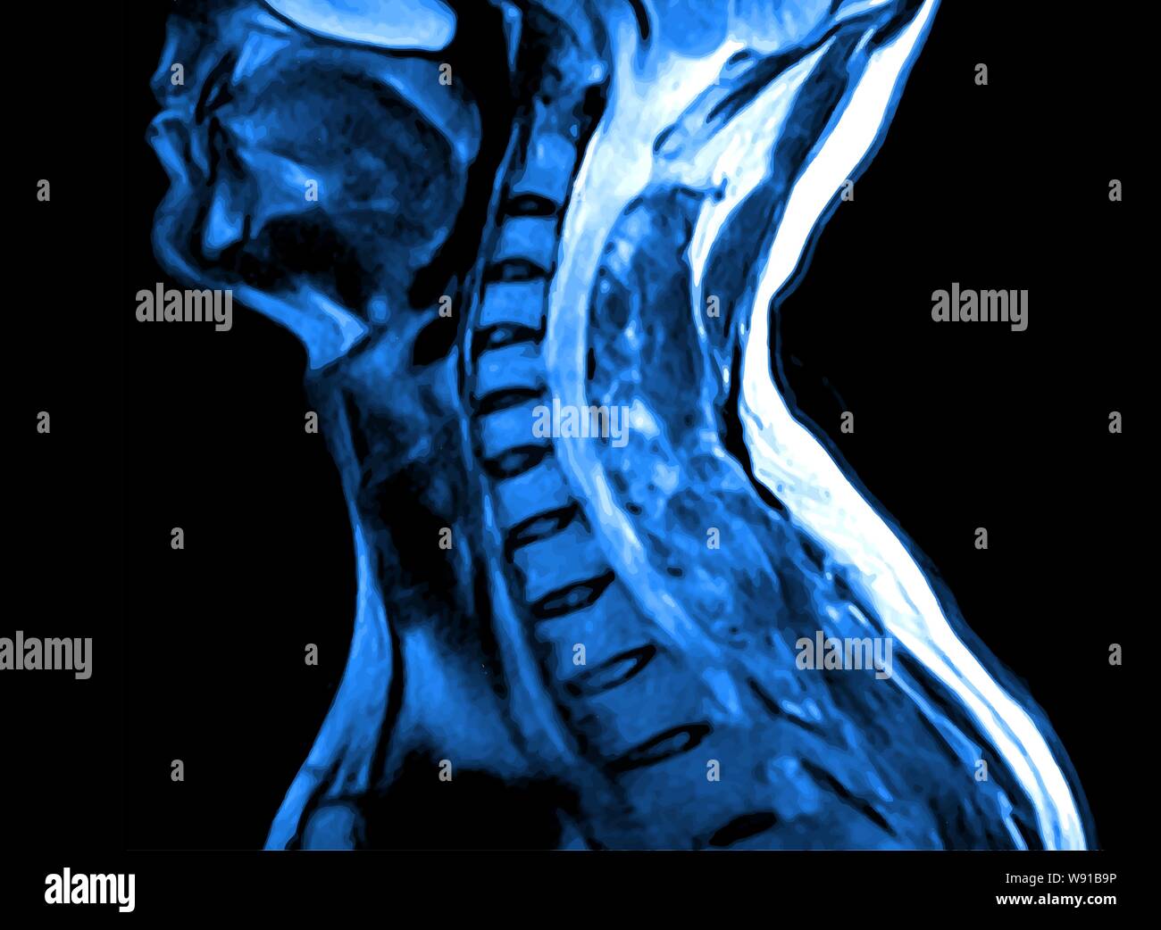 Magnetic resonance imaging of the cervical spine. Stock Vector