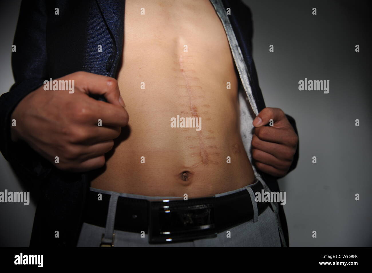 Kidney operation scar hires stock photography and images Alamy