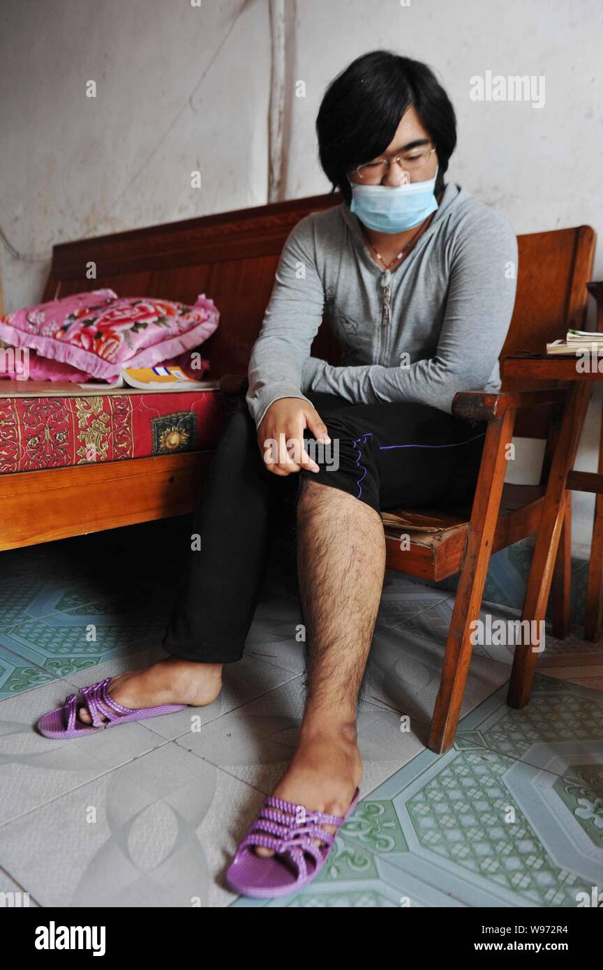 young hairy asian Young Chinese girl Na Na, who has beard and mustache on the face, shows  dense hair on her legs at home in Qianrenan village, Caozhai town, Jinhua  city Stock Photo - Alamy