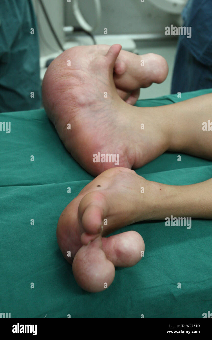 Young Chinese boy Xiao Men who has big feet lies on the bed before a  surgery in an operating room at the Childrens Hospital of Shanghai in  Shanghai, C Stock Photo -