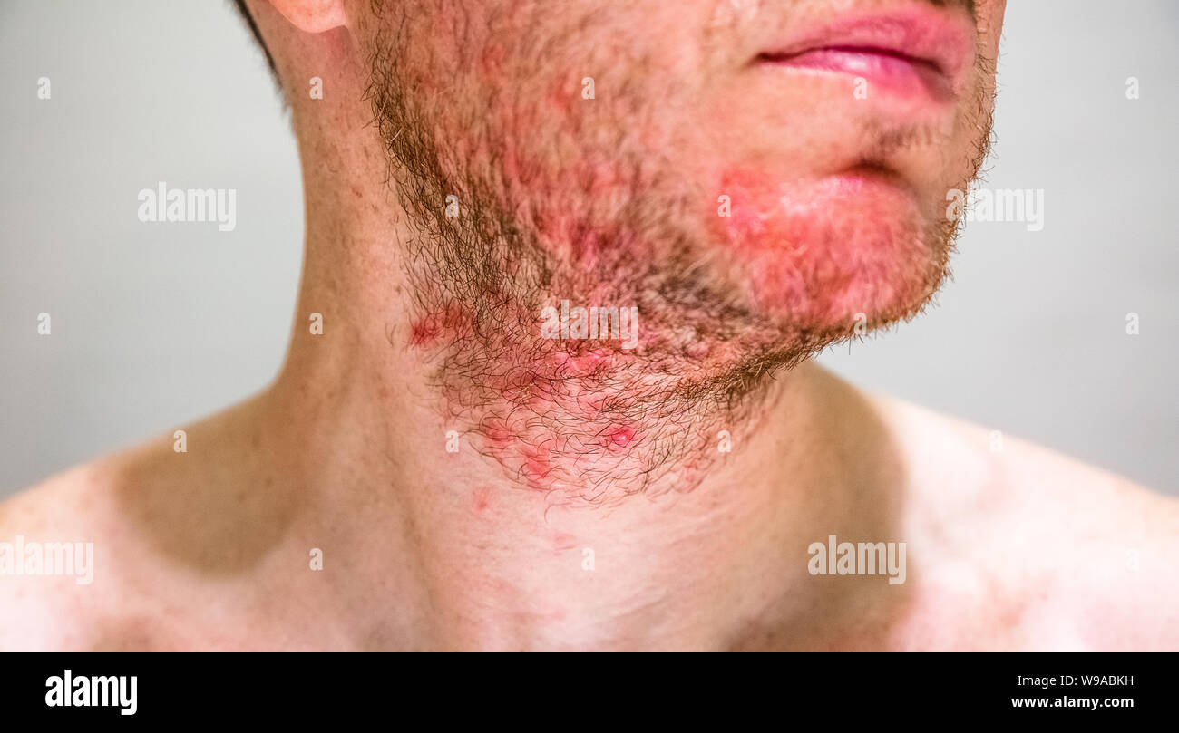 Detail of man's chin with seborrheic dermatitis in the beard area Stock Photo