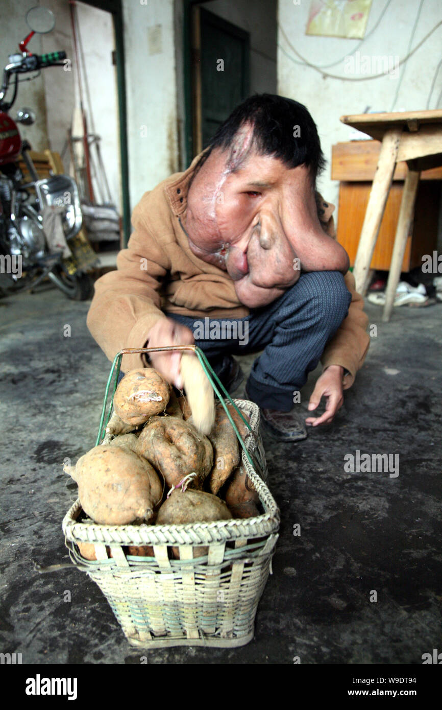 Huang Chuncai, 32, who suffers from huge tumor on the face, picks up sweet potatos at his parents grocery shop, in Yulan village of Yongxing county, C Stock Photo