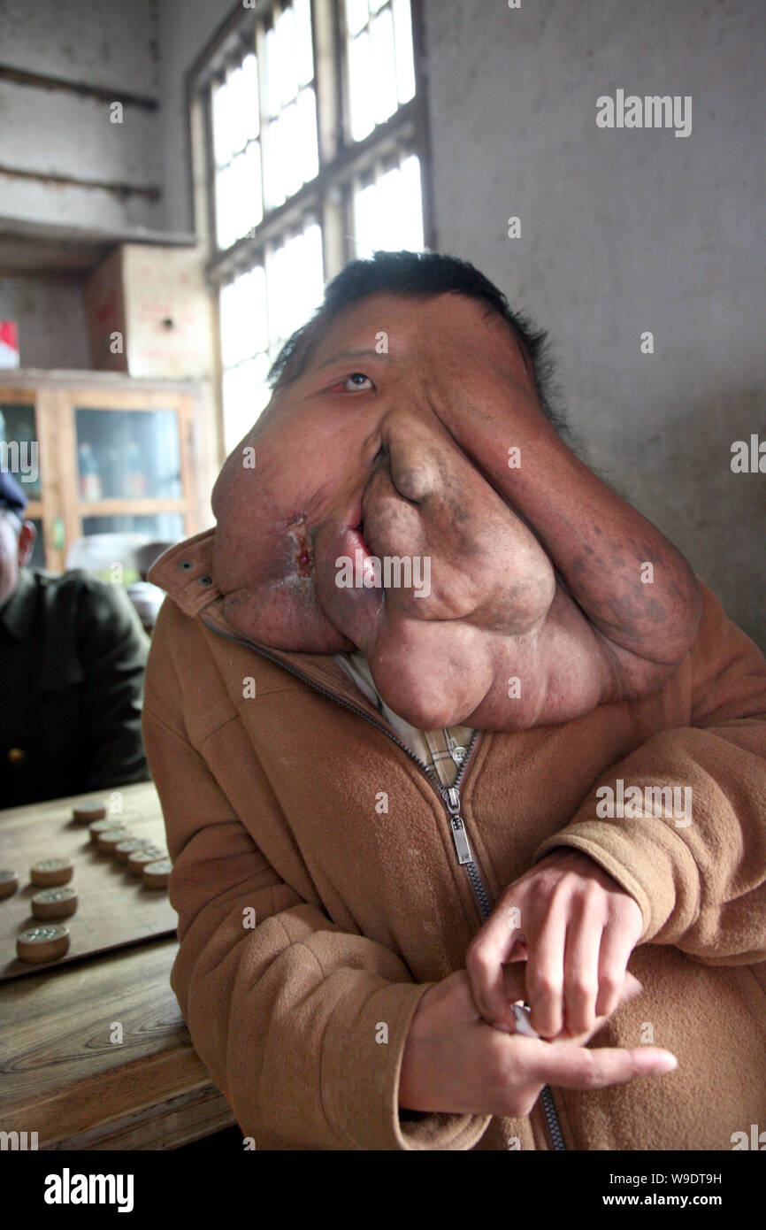 Huang Chuncai (F), 32, who suffers from huge tumor on the face, stands by a table at his parents grocery shop, in Yulan village of Yongxing county, Ch Stock Photo