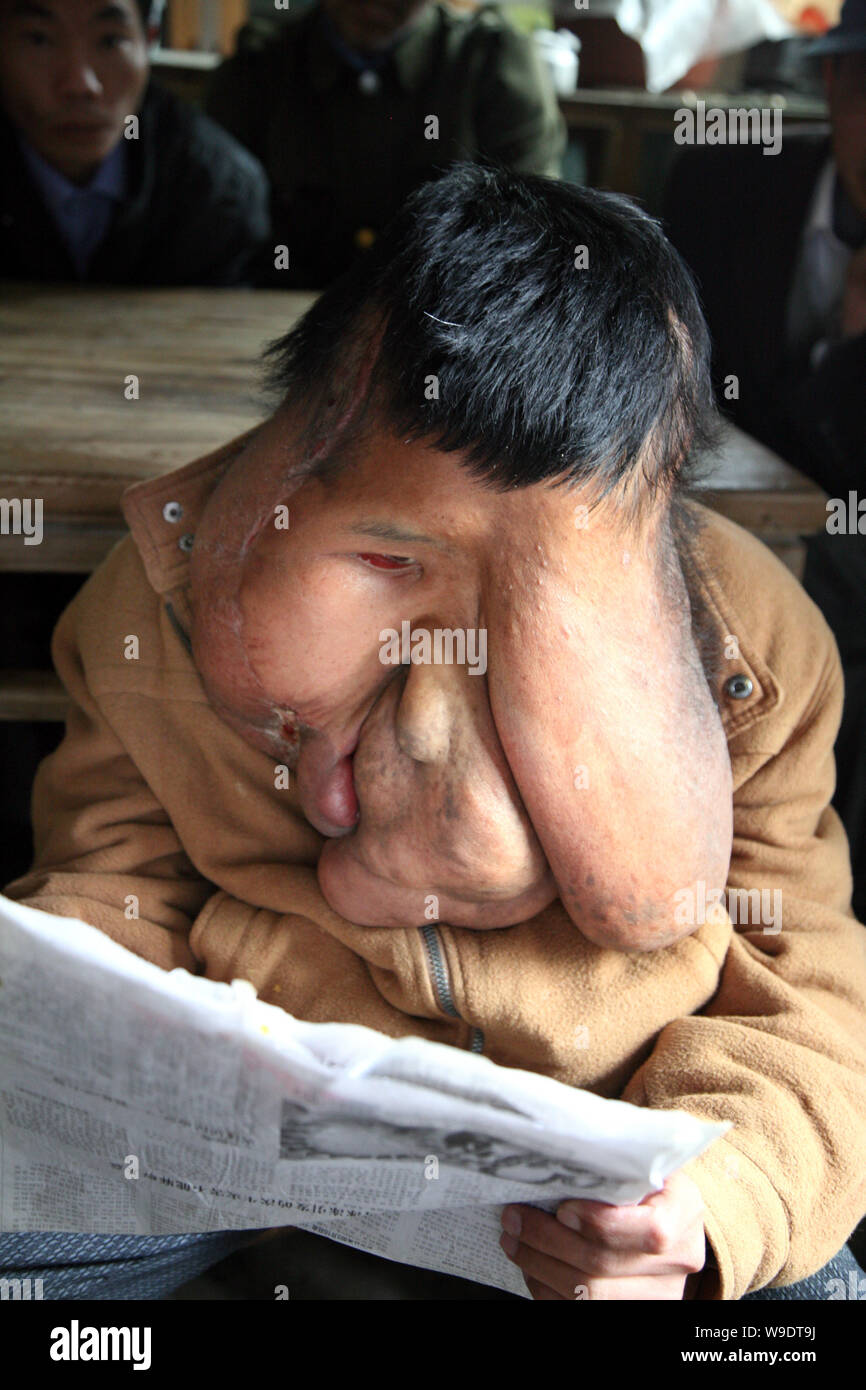 Huang Chuncai (F), 32, who suffers from huge tumor on the face, reads a piece of newspaper at his parents grocery shop, in Yulan village of Yongxing c Stock Photo
