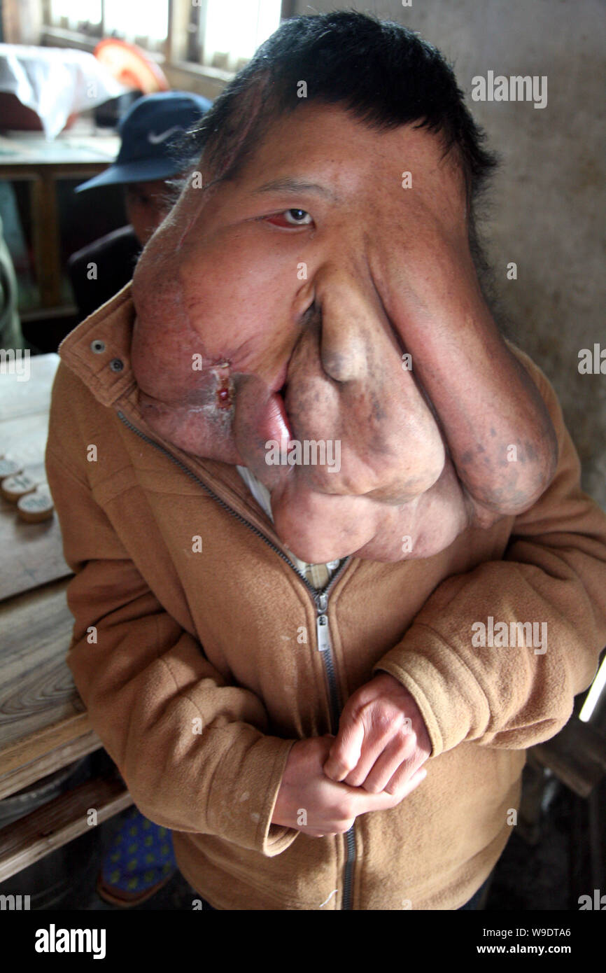 Huang Chuncai (F), 32, who suffers from huge tumor on the face, stands by a table at his parents grocery shop, in Yulan village of Yongxing county, Ch Stock Photo