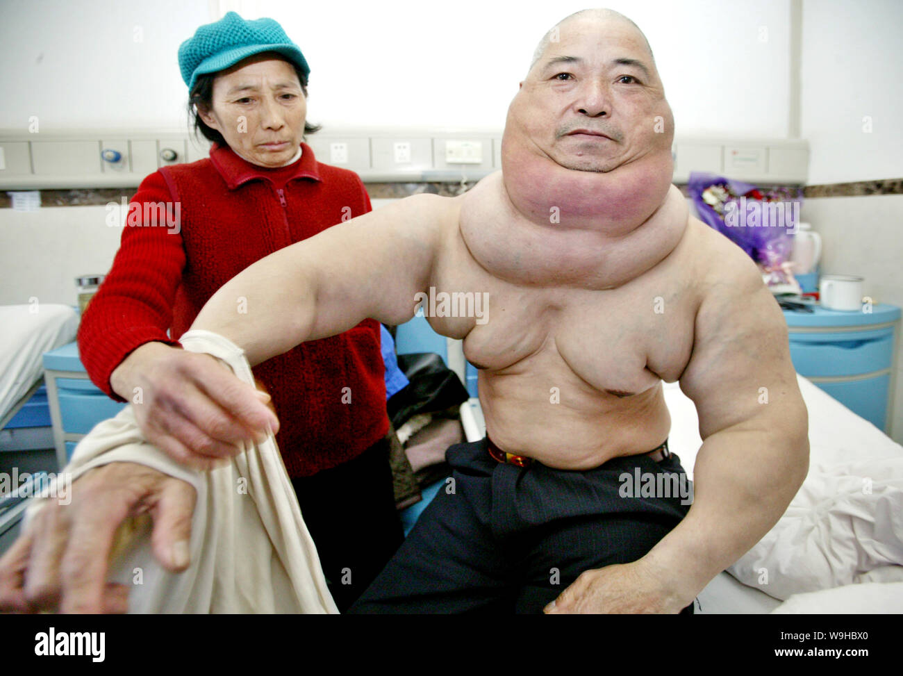 Huang Liqian (R), 58 years old takes off his clothes assisted by his wife  before tumor surgery on his neck at the First Affiliated Hospital of  Chongqi Stock Photo - Alamy