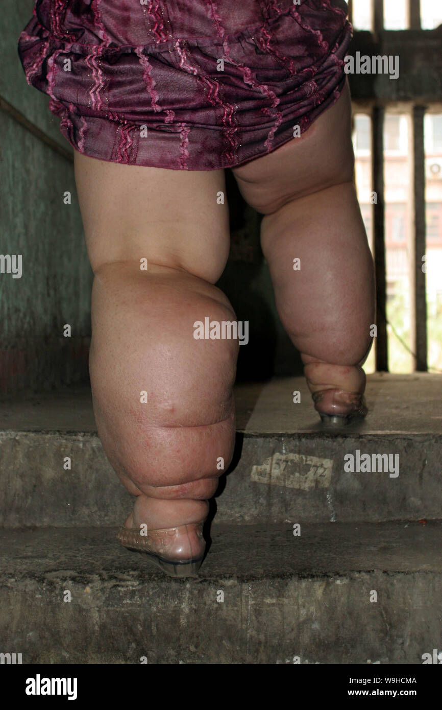 Page 2 - Fat Legs High Resolution Stock Photography and Images - Alamy