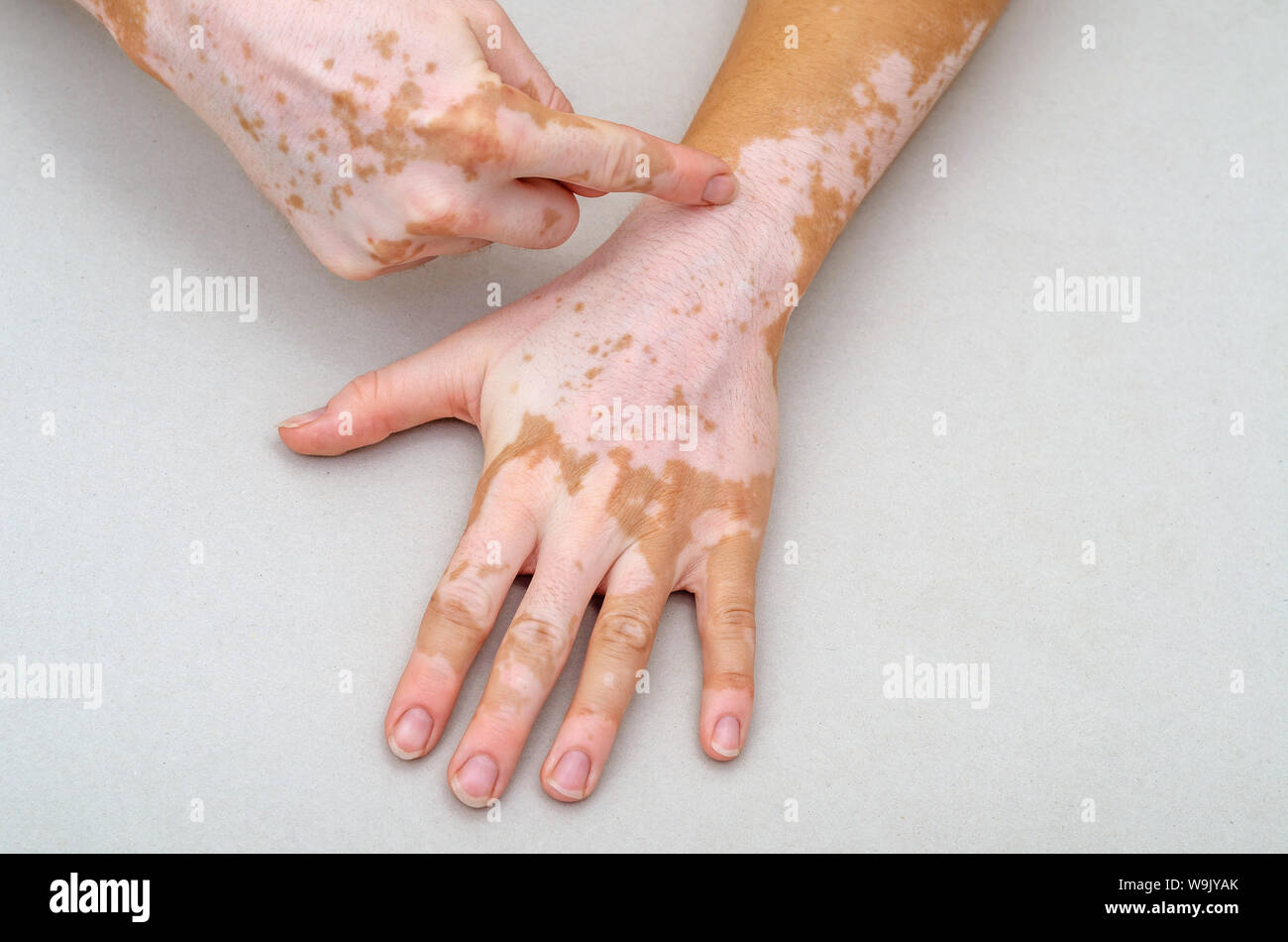 Vitiligo on the skin of hands. Finger indicates skin defect Stock Photo -  Alamy