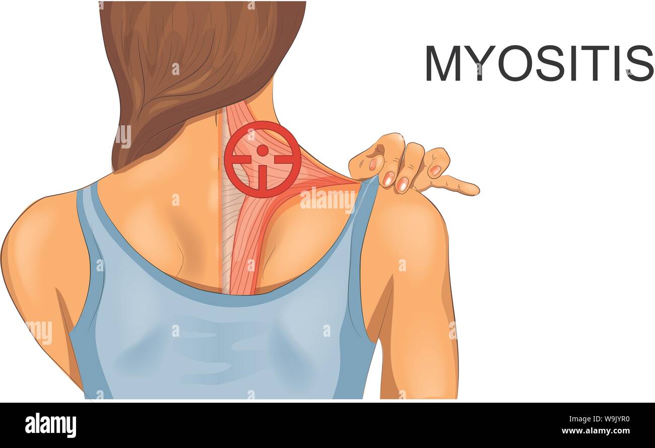 vector illustration of trapezius muscle. the incidence of myositis Stock Vector