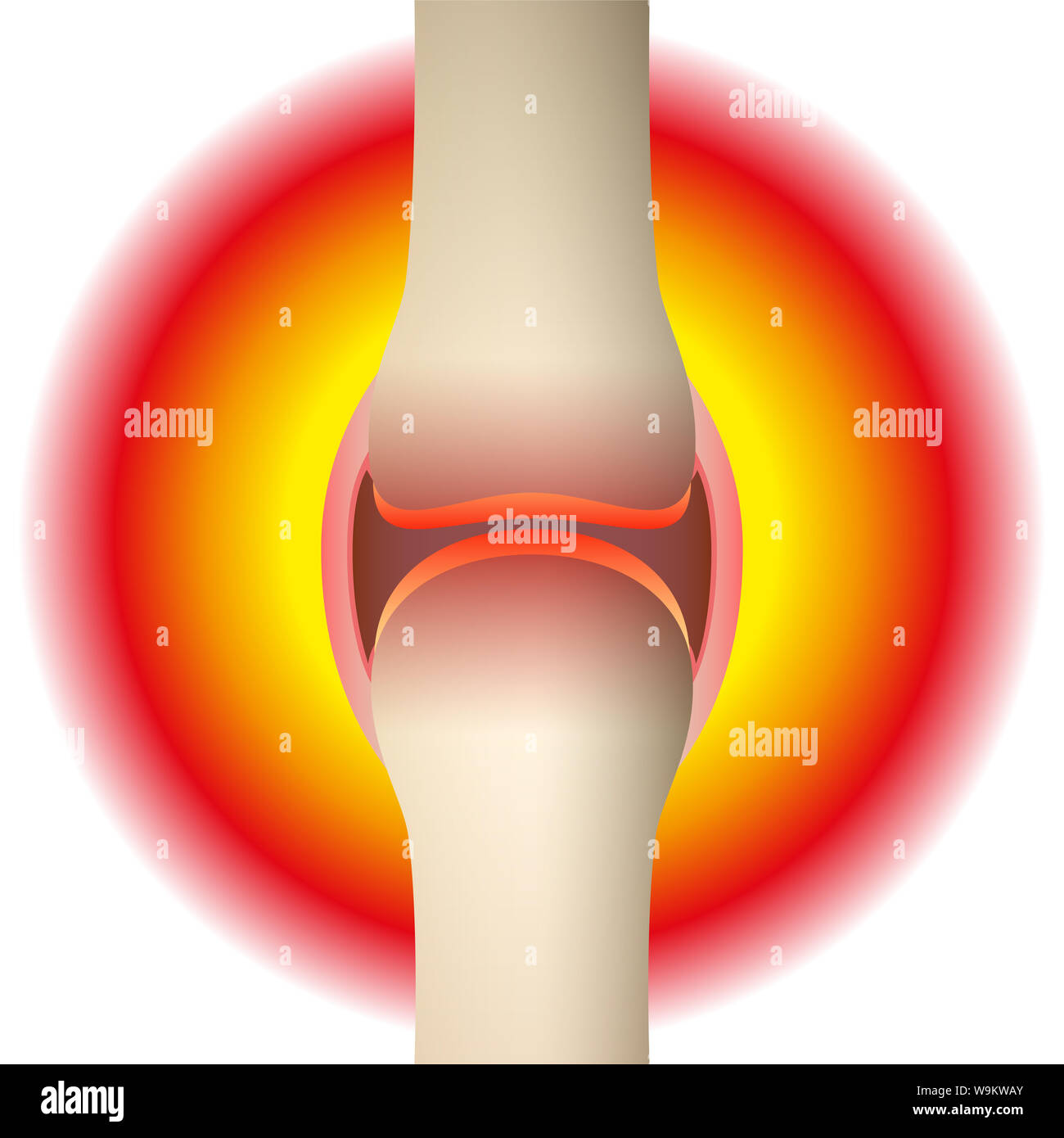 Joint pain - schematic anatomical graphic of a synovial joint with arthritis, rheumatism, gout, osteoarthritis or inflammation. Stock Photo