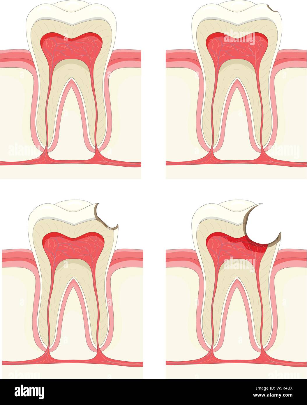 Vector set - tooth. Decay process Stock Vector