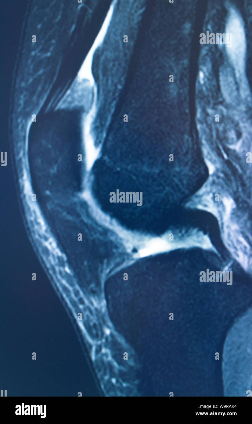 Knee sports injury mri mcl grade 2 tear resonance imaging