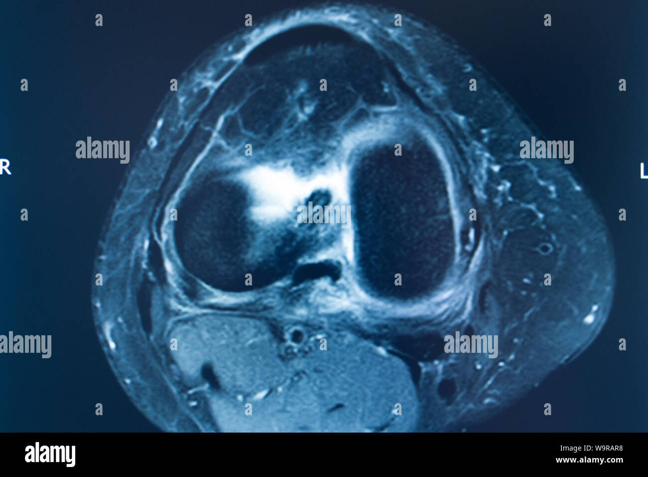 Knee sports injury mri mcl grade 2 tear resonance imaging