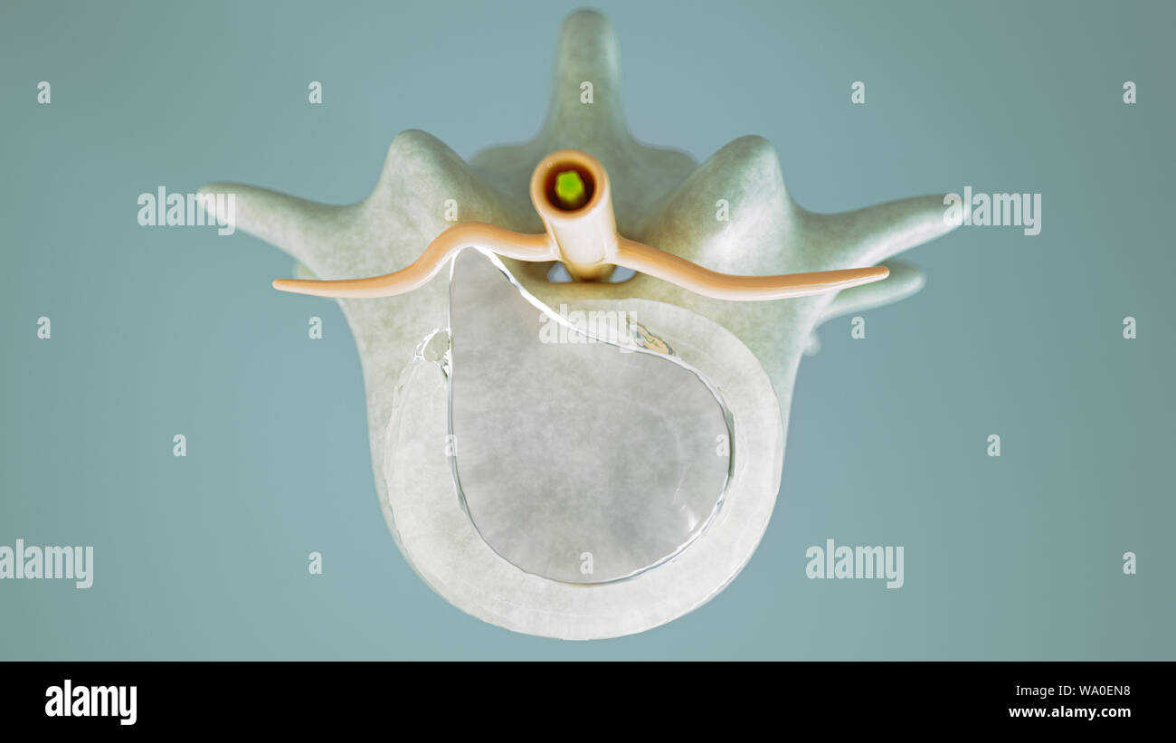 Spinal disc herniation as close-up as 3D Rendering Stock Photo