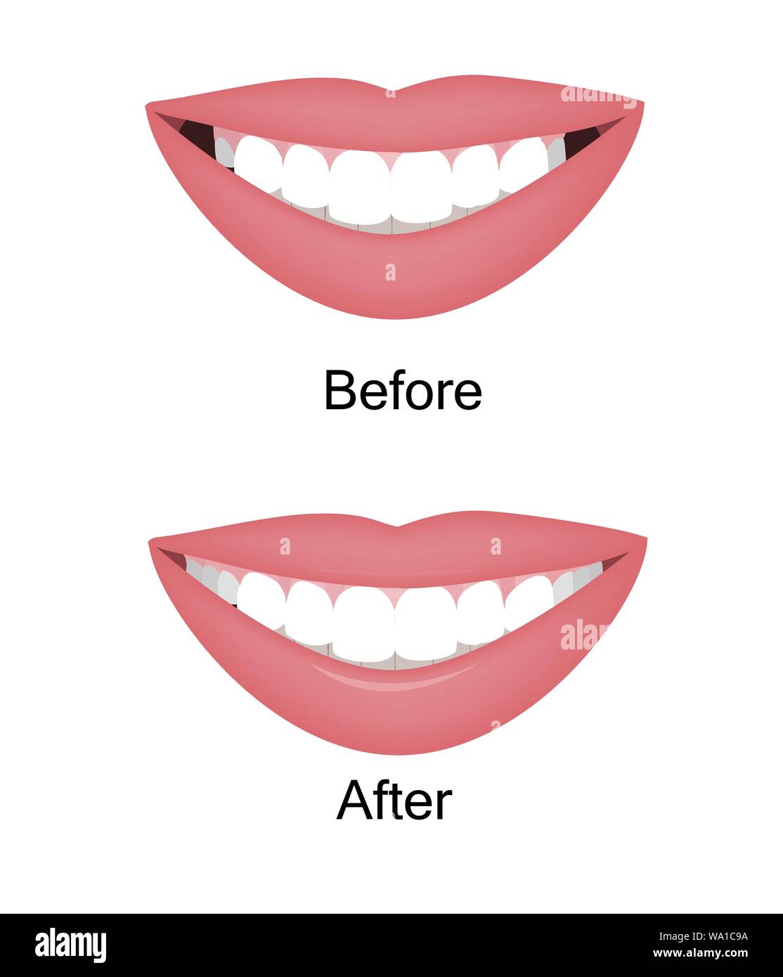 The smile with large and dark buccal corridor before and after correction. Vector illustration. Dark spaces at the edge of the smile problem treatment Stock Vector