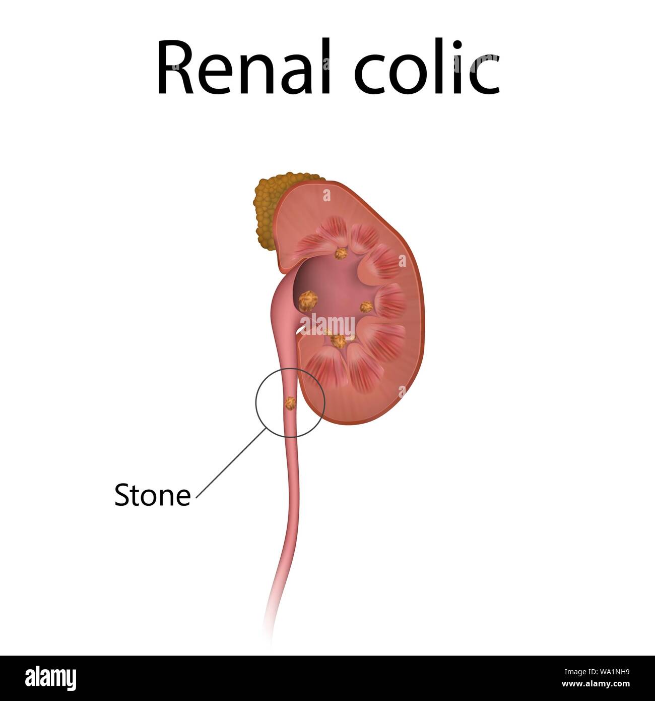 Renal colic, illustration. Stones in the kidney have caused a distended renal pelvis. Stock Photo