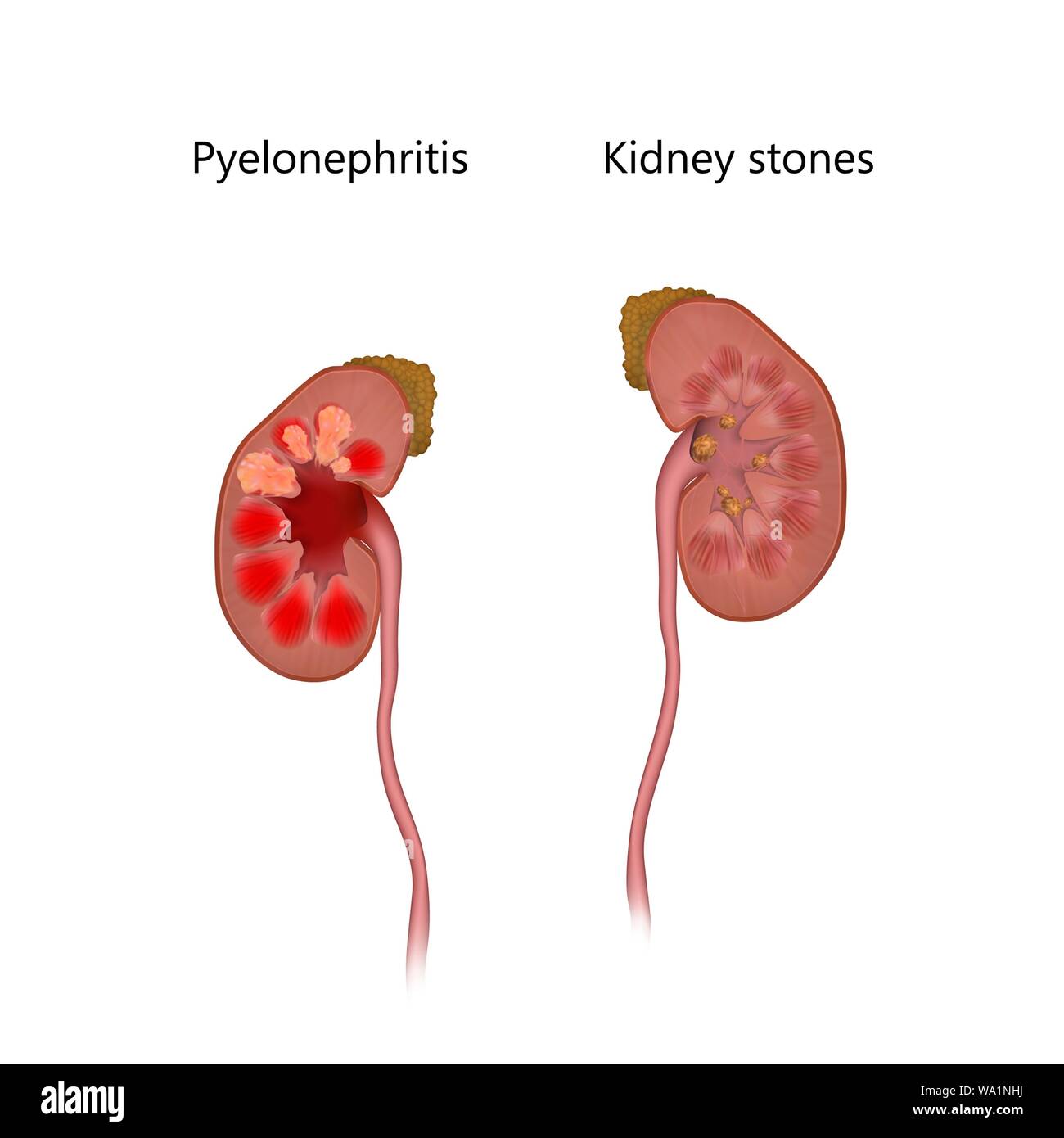 Inflamed kidney hires stock photography and images Alamy