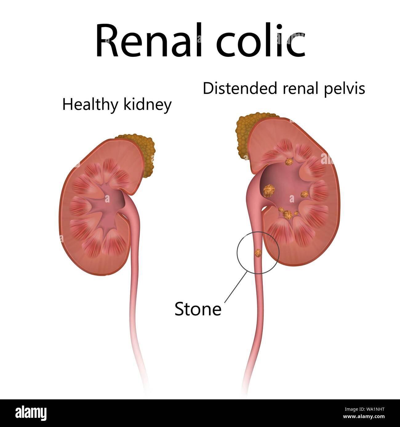 Healthy kidney, comparison with renal colic, illustration. The kidney at right has a distended renal pelvis. Stock Photo