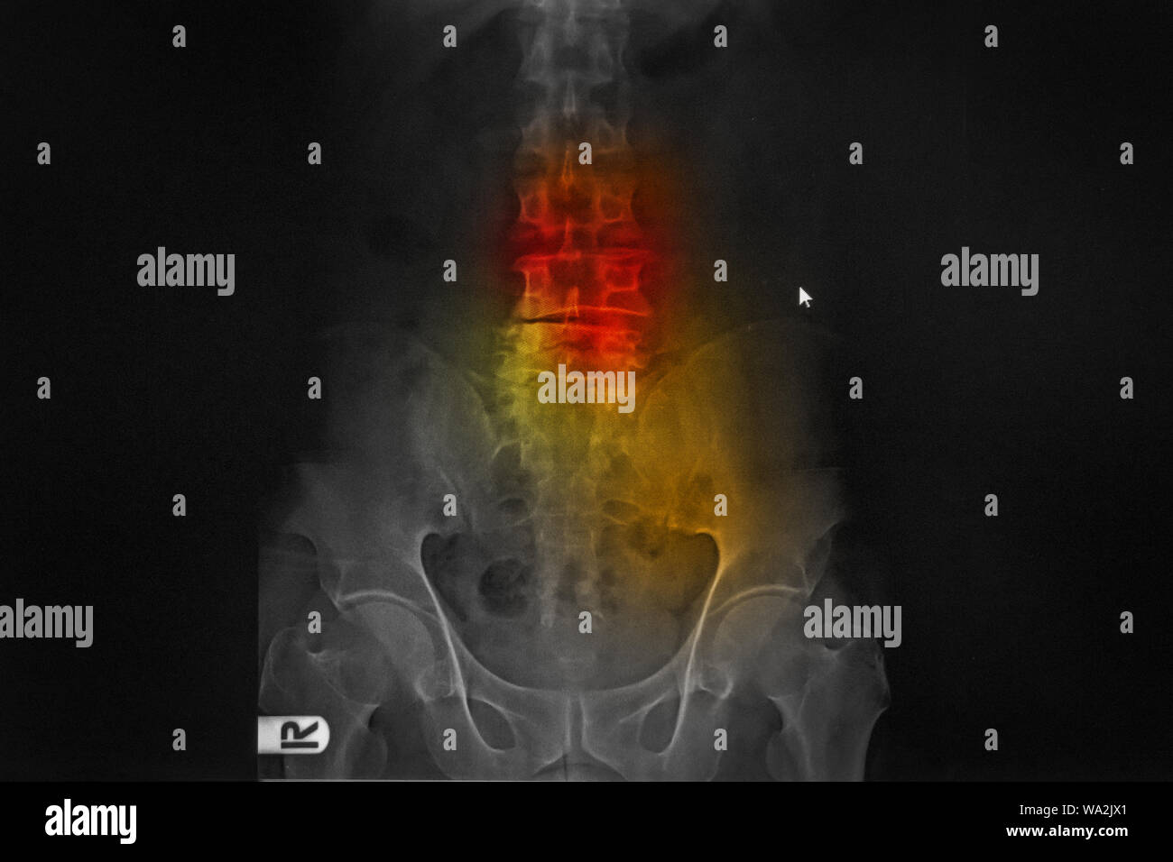 Computed radiography (CR) of lumbosarcal spine(anteroposterior(AP) view), showing spondylosis and scoliosis spine Stock Photo