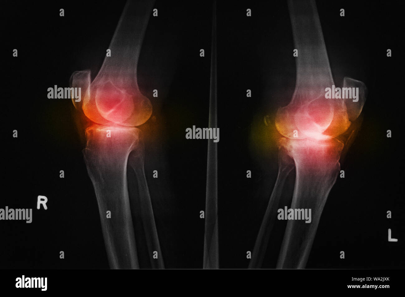 Knee osteoarthritis xray hires stock photography and images Alamy