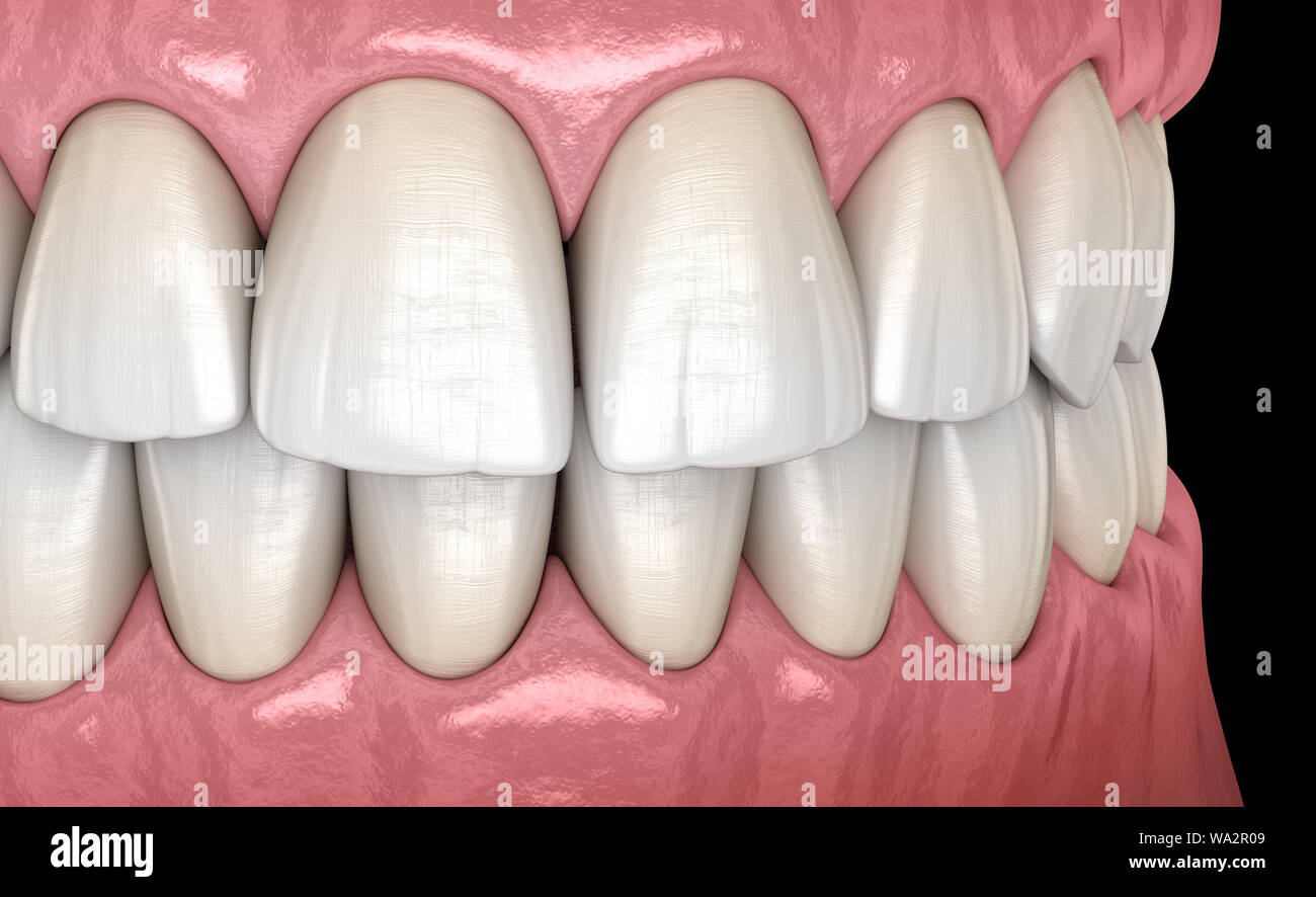 Healthy human teeth with normal occlusion, side view. Medically