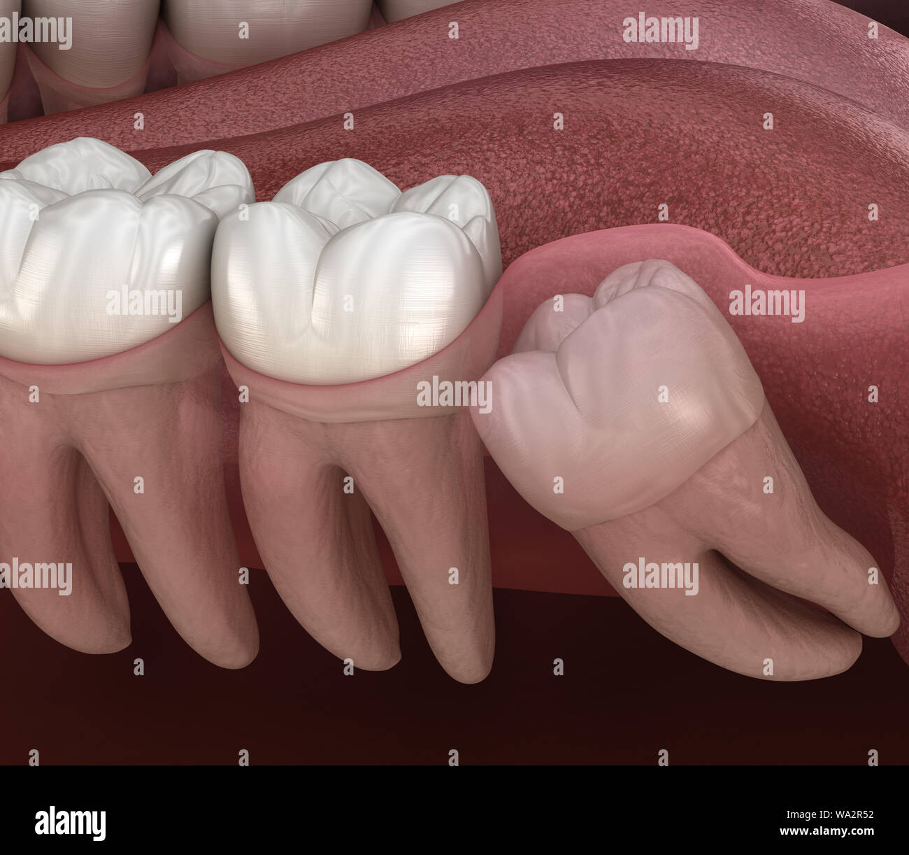 Healthy teeth and wisdom tooth with mesial impaction . Medically accurate tooth 3D illustration Stock Photo