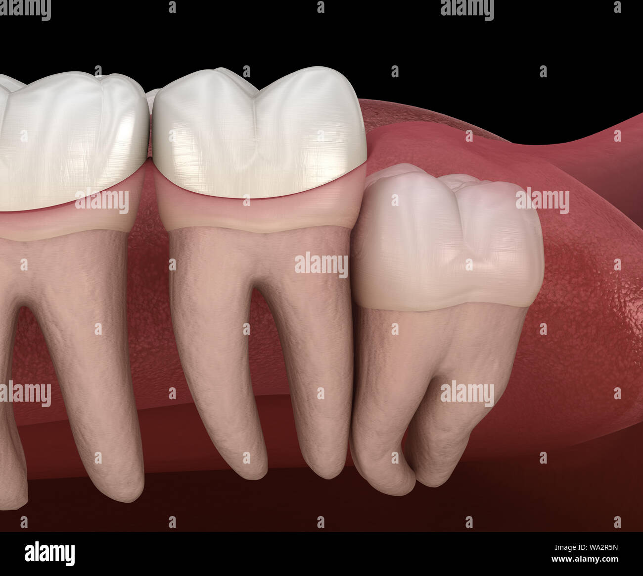 Healthy teeth and wisdom tooth with vertical impaction . Medically accurate tooth 3D illustration Stock Photo