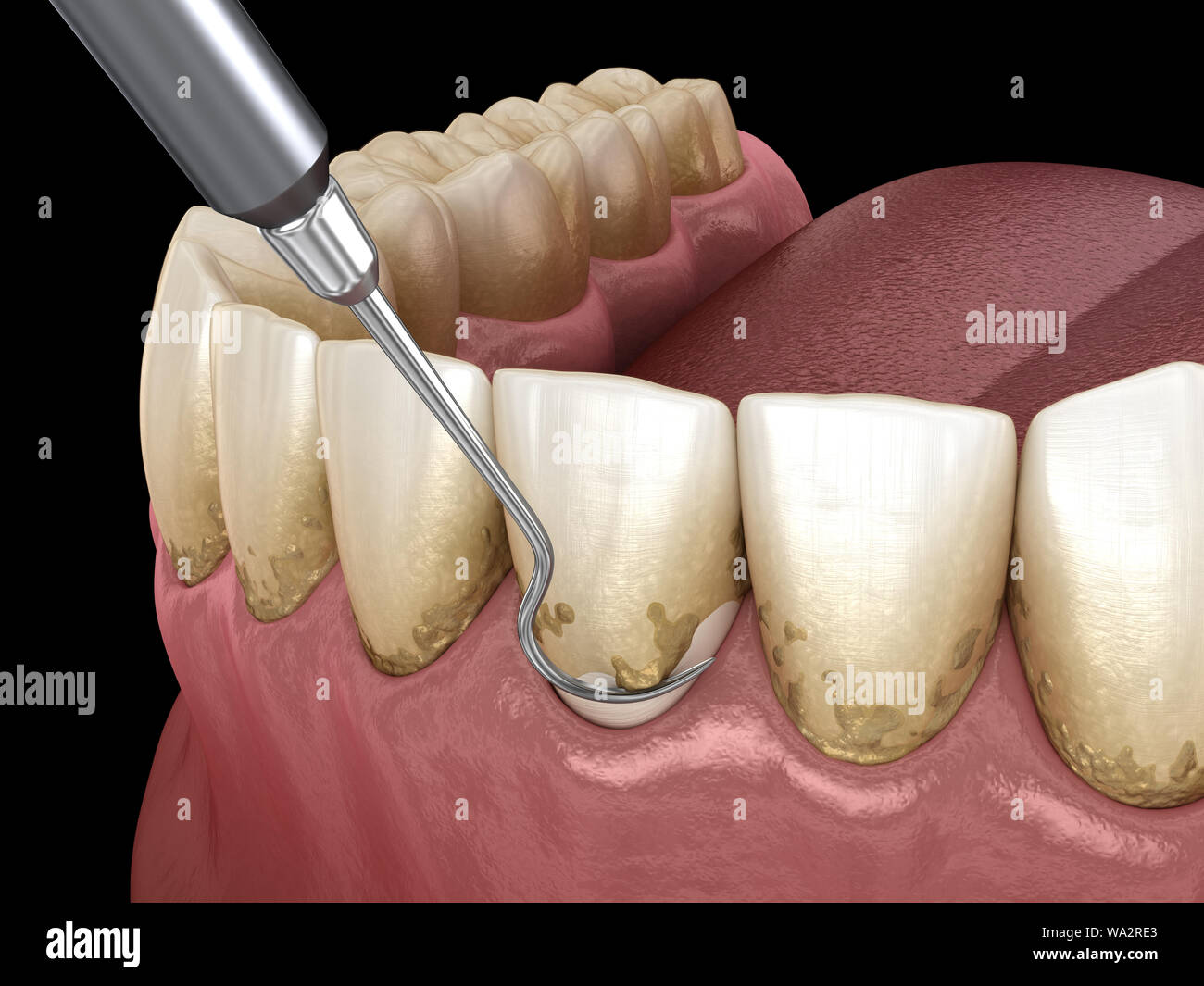 Oral hygiene Scaling and root planing (conventional periodontal therapy). Medically accurate 3D